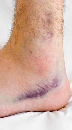 Sprained heel clearance