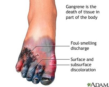 gangrene